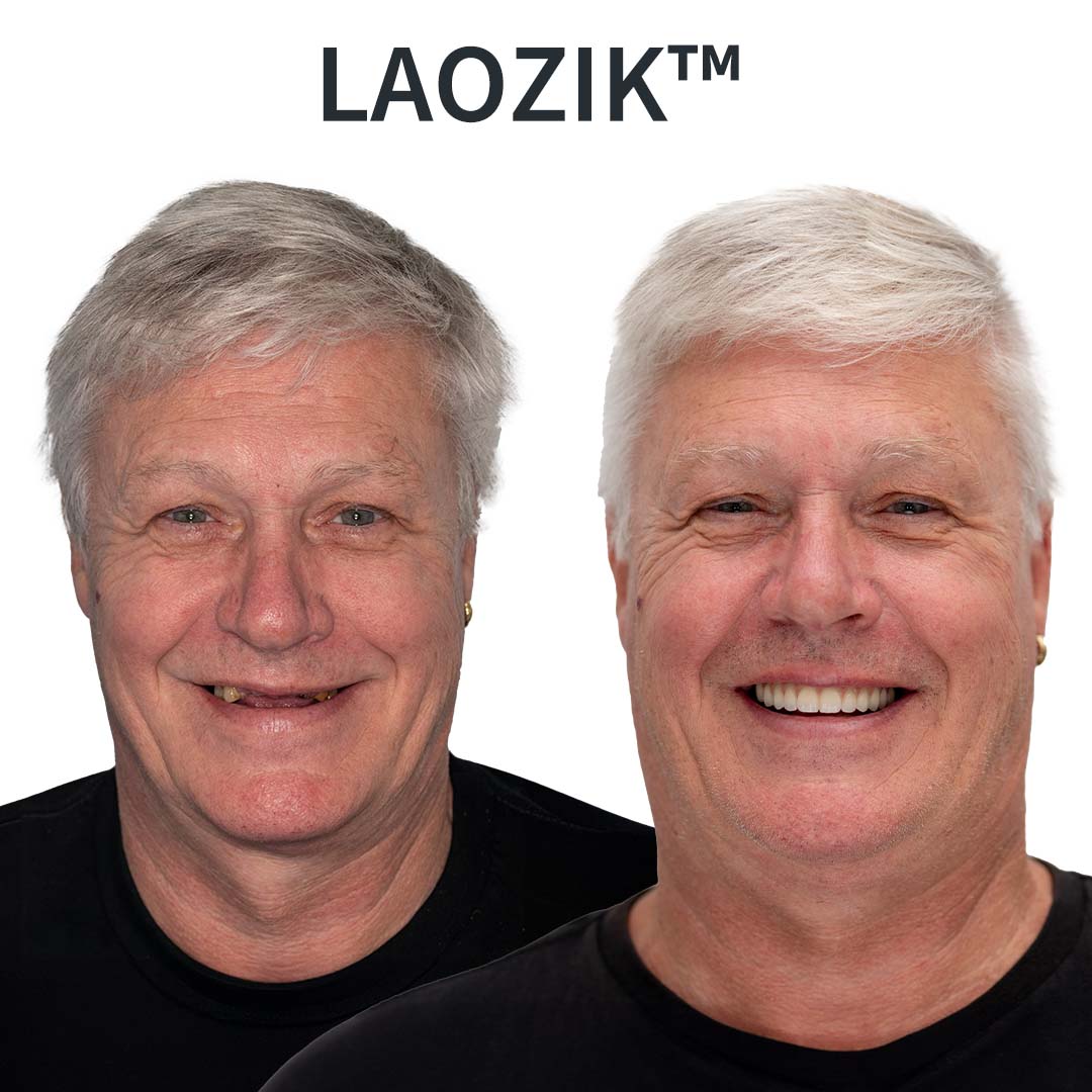 AdaptableFit funkcionális protézisek