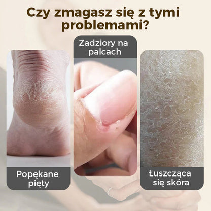 🎁💥Intenzíven regeneráló balzsam repedezett sarkakra és száraz kézre